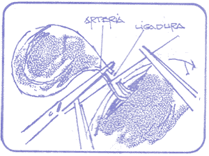 Técnicas de castración del cerdo - Image 12