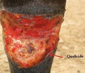Manejo de tejido de granulación (queloide) en heridas de finasangre de carrera - Image 3