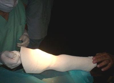Fractura Proceso Extensor de la tercera falange en equinos - Image 7