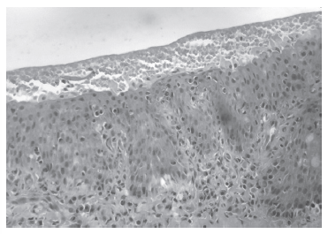 Figura 2: Bovino, corte histológico de mucosa nasal. Acantosis, exocitosis difusa, con infiltrado inflama-torio a predominio eosinofílico. H&E 100X.