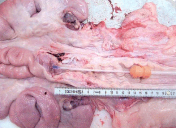 Foto 2: Posición del catéter y la cánula en la Inseminación Artificial Post-Cervical (IAPC)