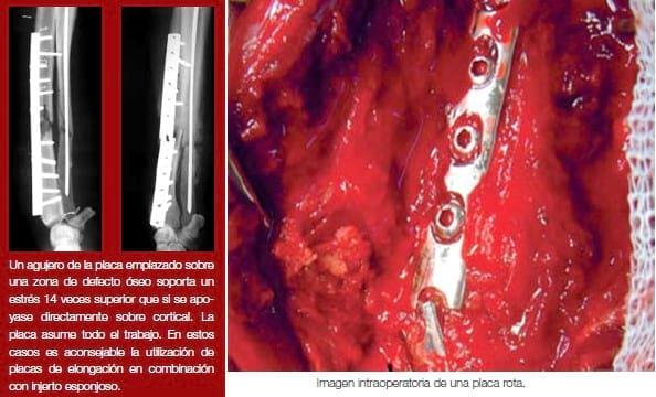 Complicaciones de fracturas reparadas con placas y tornillos - Image 11