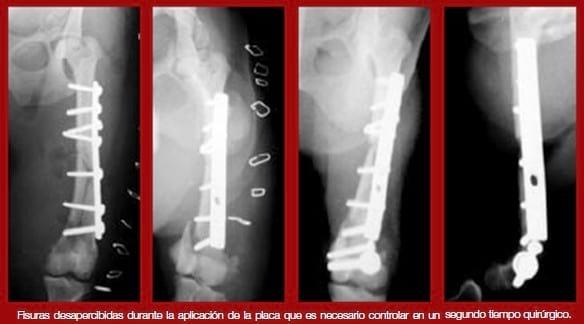 Complicaciones de fracturas reparadas con placas y tornillos - Image 10