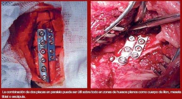 Complicaciones de fracturas reparadas con placas y tornillos - Image 6