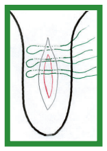 Manual de anestesias y cirugías de bovinos: Cirugías de los pezones - Image 3