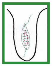 Manual de anestesias y cirugías de bovinos: Cirugías de los pezones - Image 2