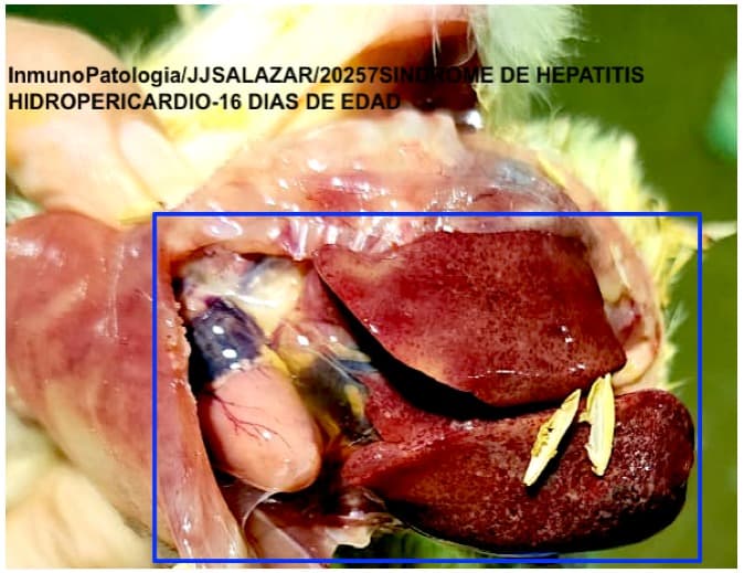 Inmunopatología - Síndrome de Hepatitis / Hidropericardio - 1