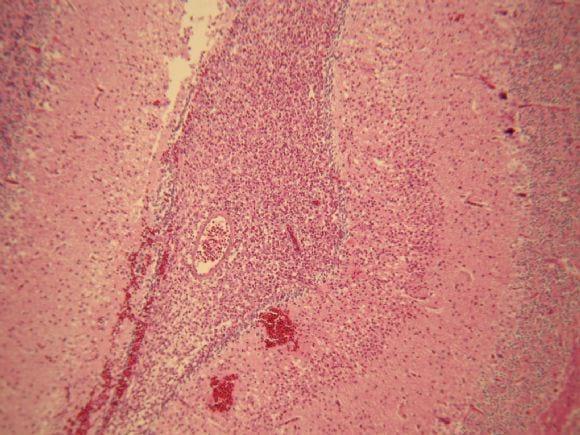 Meningitis Bacteriana