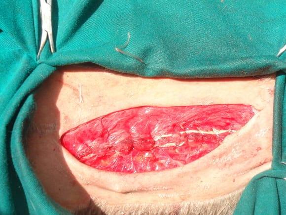 Cierre de pared abdominal ventral