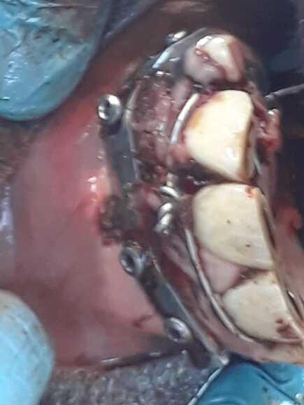 Corrección de fractura mandibular