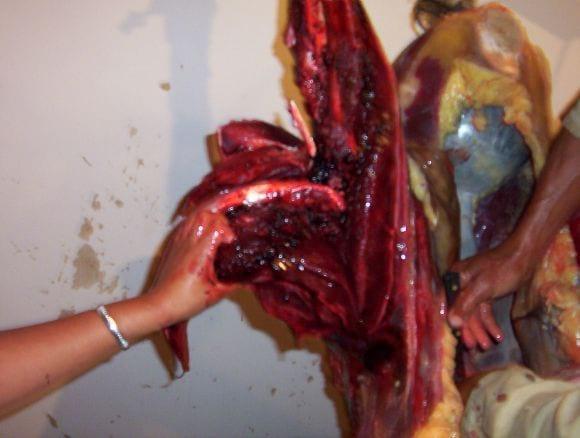fractura