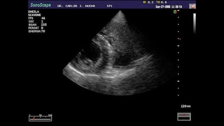 Rabdomiosarcoma infiltrativo en Ventriculo Derecho en un canino