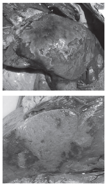 Figura 1: Bovino, área de necrosis hepática focal extensa bien delimitado por un área de hiperemia.