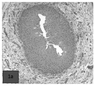 Foto 1a) Metaplasia de conductos interlobulillares parotídeos.