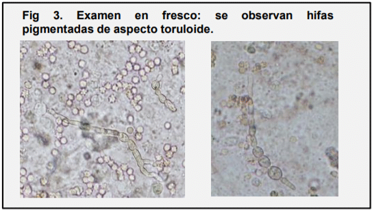 Fig 3. Examen en fresco: se observan hifas pigmentadas de aspecto toruloide.