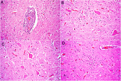 Figura 1. Lesiones histológicas en la vaca con encefalitis por astrovirus bovino neurotrópico; coloración de hematoxilina y eosina, ×400. A) Infiltración de linfocitos, macrófagos y células plasmáticas en un espacio perivenular en la corteza cerebral. B) Gliosis e infiltración de linfocitos en el neurópilo del tronco encefálico. C) Una neurona (centro de la imagen) en el tronco encefálico presenta hipereosinofilia citoplasmática y núcleo picnótico (necrosis neuronal). D) Una neurona necrótica en la corteza cerebral se encuentra rodeada de células gliales e inflamatorias (satelitosis) e invadida por dichas células (neuronofagia).