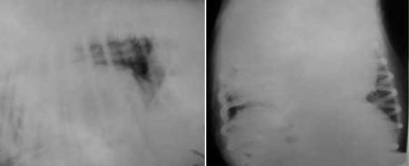 Presentación de un caso de: Hernia Diafragmática Peritoneo-Pericardica - Image 1