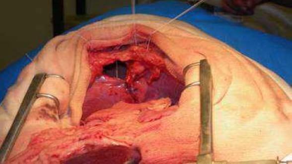 Presentación de un caso de: Hernia Diafragmática Peritoneo-Pericardica - Image 4