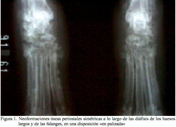 Osteopatía hipertrófica canina: relato de caso - Image 1