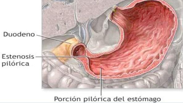 Estenosis hipertrófica pilórica – piloroespasmo. Reporte de un caso - Image 2