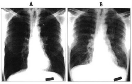 Hantavirus - Image 2