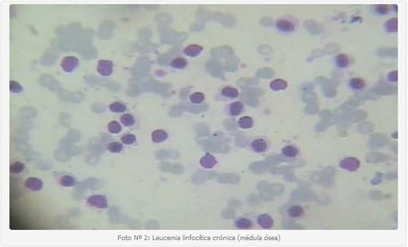 Leucemia linfocítica crónica en felinos: primer caso reportado en el Hospital Escuela de la Facultad de Ciencias Veterinarias UBA. - Image 2