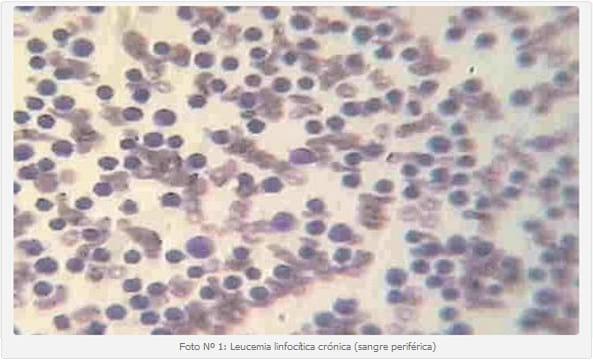 Leucemia linfocítica crónica en felinos: primer caso reportado en el Hospital Escuela de la Facultad de Ciencias Veterinarias UBA. - Image 1