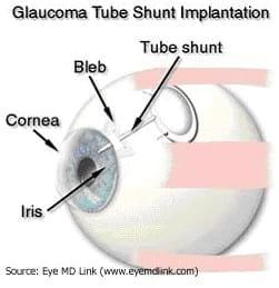 Cirugía del Glaucoma: Gonioimplante - Image 2