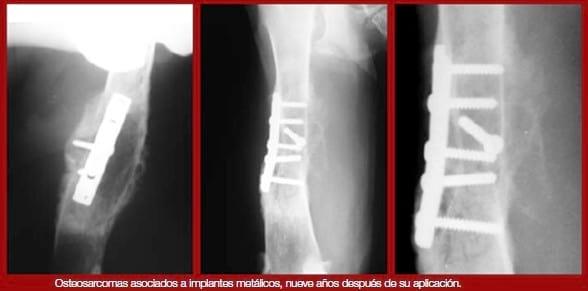 Complicaciones de fracturas reparadas con placas y tornillos - Image 7
