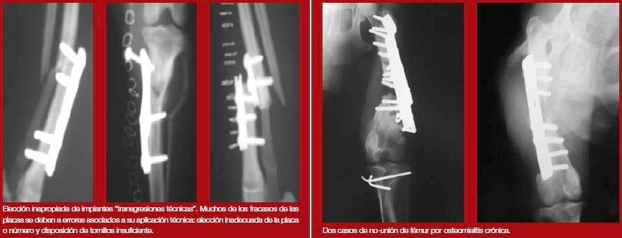 Complicaciones de fracturas reparadas con placas y tornillos - Image 2