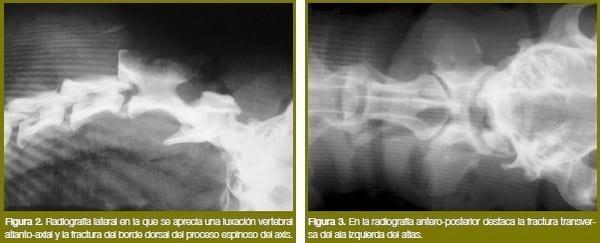Luxación vertebral atlanto-axial traumática - Image 2