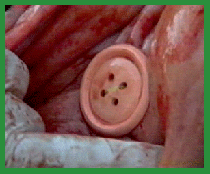 Manual de anestesias y cirugías de bovinos: Cirugías de Abdomen - Image 18