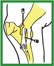 Manual de anestesias y cirugías de bovinos: Cirugías de las extremidades - Image 26