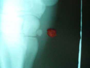 Luxación y/o fractura del primer hueso del carpo y su solución quirúrgica - Image 8