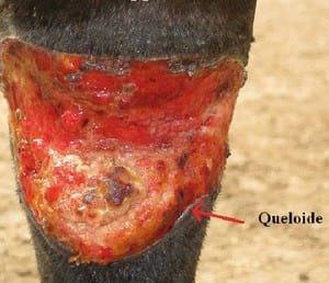 Manejo de tejido de granulación (queloide) en heridas de finasangre de carrera - Image 3