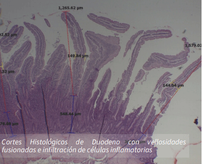 Cortes Histológicos de Duodeno con vellosidades fusionadas e infiltración de células inflamatorias