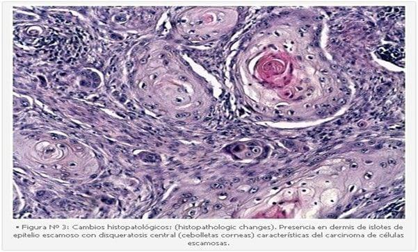 Tratamiento Tópico del Carcinoma de Células Escamosas (CCE) Cutáneo Felino en Forma Tópica con 5 Fluoruracilo (5 FU): Descripción de un Caso Clínico. - Image 3